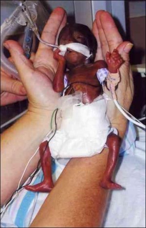 Лікар шпиталю міста Хоумстед, що у американському штаті Флорида, тримає на руках Емілію Тейлор. Дівчинка народилася з вагою у 300 грамів, зараз вона важить 1800
