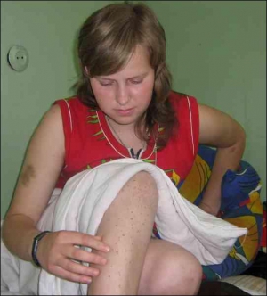 На лівій нозі Галина Габрильчук нарахувала півсотні запечених цяток від кульової блискавки