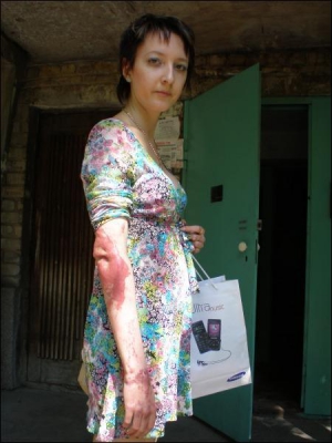 Луганчанка Ганна Бабакова показує понівечену вогнем руку. Їй ніяково, коли її каліцтво лякає перехожих. Навіть у нестерпну спеку дівчина одягає сукню з довгим рукавом