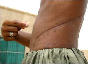 Пакистанець Амджад Алі показує шрам на тілі після операції з видалення нирки. Він продав її на пересадку за 300 доларів. У Пакистані торгівля людськими органами законна, тому країну називають ”ринком нирок”