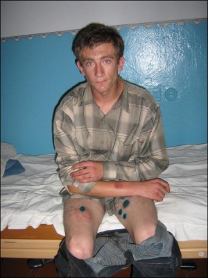 19-летний Сергей Стасюк в больнице Гайсина на Винниччине. На ногах — ожоги от молнии