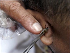 Египетский врач Хадж Мохамед Эль-Миньяви позволяет пчеле вжалити пациента с больным ухом. Врач говорит, что пчелиными укусами можно лечить болезни почек, аппендицит, рак
