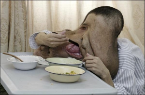 Хуан Чуньцай обедает в палате больницы после того, как ему удалили большую часть 23-килограммовой опухоли на лице. Мужчина из села в северной провинции Хунань раньше не мог говорить и есть