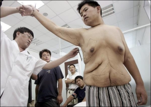 27-летний Менг Цингань из китайской провинции Хейлунцзян проходит обследование перед тем, как ему стрежут обвисшую после быстрого похудения кожу