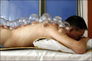 Пацієнтові поставили банки в клініці традиційного китайського масажу та голковколювання ”Ґуангжіґуо” в Шанхаї. У закладі таким методом лікують усі хвороби, а не лише недуги дихальної системи