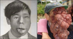На фото ліворуч португалець Жозе Местре в підлітковому віці, коли на його обличчі почала розвиватися пухлина. Нині вона закриває око та блокує дихальні шляхи