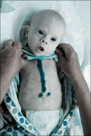 Один из нескольких детей с вродженной патологией сердца после операции