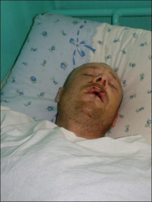 Микола Козіс лежить у лікарні в райцентрі Кобеляки Полтавської області. Запевняє, що міліціонери його побили, а до машини підкинули наркотики