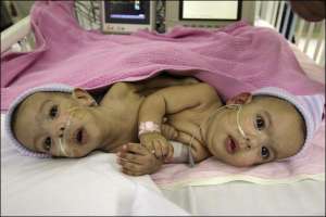 Шрамы от операции у сиамских близнецов Сафы и Марвы исчезнут через несколько лет