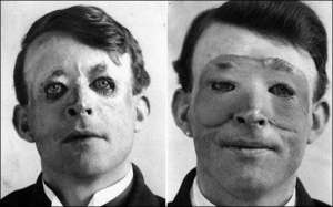 На фото ліворуч британський моряк Волтер Йео після операції з пересадки шкіри й курсу реабілітації. Правороч — під час лікування в шпиталі хірурга Гарольда Джилліса