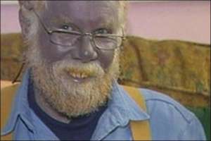 Пол Карасон приймав колоїдне срібло від дерматиту декілька років. Через це його обличчя посиніло