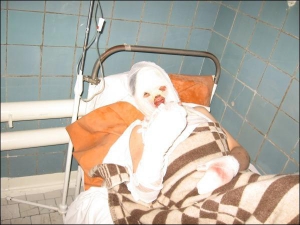 Оксана Олейнікова лікується у Хмельницькому опіковому центрі. Жінка упевнена, що міліціонер спеціально її підпалив