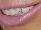 Передний зуб Маши инкрустирован бриллиантом