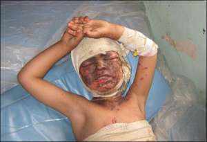 Афганский мальчик с ожогами тела лежит в госпитале города Фара на востоке страны. Ребенок попал под бомбардировку американских пилотов