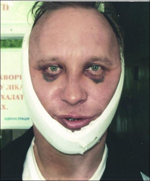 Учитель музики, співів і праці Хмельницької міської школи №25 Леонід Василець на виході з обласної лікарні. Випускники зламали йому праву виличну кістку, кістки носу і верхню щелепу