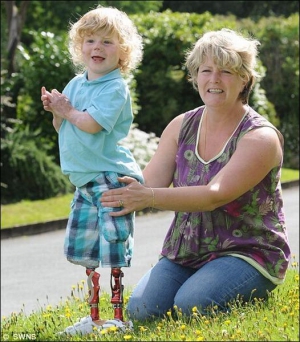 3-річний Арчі Бартон із матір’ю Нікі. Через менінгіт дитина втратила ноги й зір. Арчі вчиться ходити на біонічних протезах
