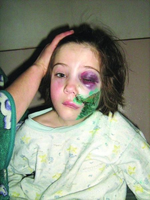 Любовь Карук лежит в Тернопольской областной детской больнице. У нее опухло лицо, левый глаз не открывается, на щеку наложили швы