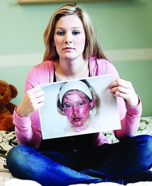 У Єви Уйлін від реакції на парацетамол повністю злізла шкіра. Вона відновилася за чотири роки