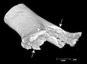 Ученые создали трехмерное компьютерное изображение отрезанной конечности человека, жившего семь тысяч лет тому назад. Стрелками указаны места, по которые древний хирург прошелся кремневым ”скальпелем”