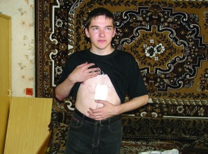 Вінничанин Юрій Кондратенко показує рану на грудях. Його поранив водій чорного БМВ. Розлютився, що той вийшов перед машиною на пішохідний перехід