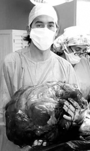 Чотири години хірурги вирізали пухлину на матці пацієнтці з аргентинського міста Ломас-де-Замора