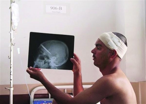 Бразилець Еделісон Насціменто показує рентгенівський знімок свого черепа. Три роки тому йому встромили в голову ніж. Ручку ножа лікарі витягли, лезо діставати побоялися