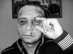 Сергій Калашніков лікується у щелепно-лицьовому відділенні Хмельницької обласної лікарні