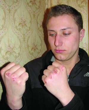 Віктор Качалуп показує збиті кулаки