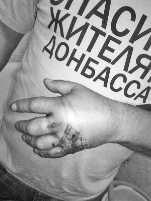Активіст громадського руху ”Спільна справа” Андрій Орест показує прострелену руку. Кулю отримав 19 вересня за те, що ходив столичною вулицею у футболці ”Спасибо жителям Донбасса”