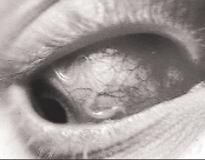 У половини хворих на дирофіляріоз черви живуть в оці. Глисти ховаються під повіки