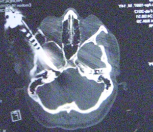 Рентгенівський знімок тернополянина Станіслава Чебіряка. Ніж увійшов у голову на 10 сантиметрів