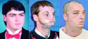 Американець Річард Лі Норріс 15 років тому вистрелив собі в обличчя. Переніс 14 операцій. У березні йому пересадили донорське обличчя разом із зубами та язиком
