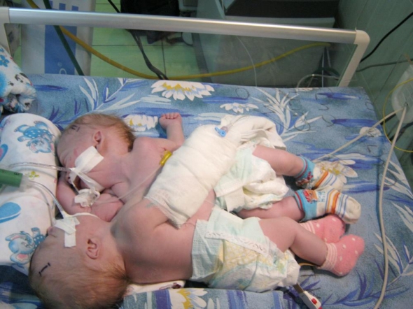 У девочек срослись сердца