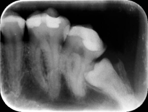 Знімок показує, що нижній правий зуб мудрості росте вбік і руйнує сусідні зуби. Такий зуб необхідно видаляти. Вирівняти його неможливо