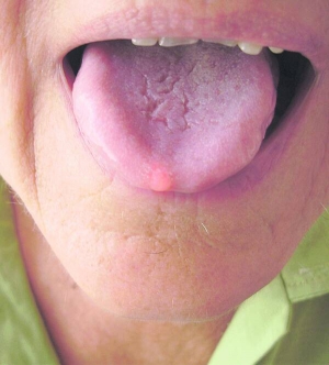 У черкаски Віри Коваль на язиці виросла доброякісна папілома. Натерла її об надщербленого нижнього зуба. Може переродитися на злоякісну пухлину