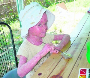 7-річна Вікторія Васьковська з Житомирщини має важку форму псоріазу. У неї злущується шкіра на всьому тілі