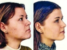 Шкіра обличчя вкрита демодексом до застосування трав’яних засобів та чиста після