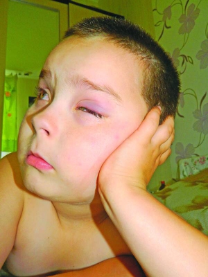 6-річний Дмитро Цуркановський із села ­Сосонка на Вінниччині лікував кон’юнктивіт три тижні. Під час хвороби бачив на 30 відсотків