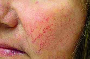 Судинна сітка на обличчі — купероз — виникає через ламкість кровоносних судин
