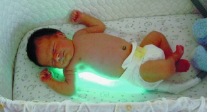 Під фотолампою немовлята лежать цілодобово. Незапущена жовтяниця минає за два–три дні