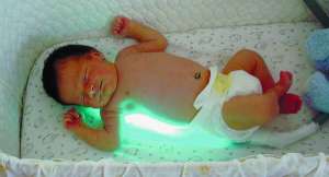 Під фотолампою немовлята лежать цілодобово. Незапущена жовтяниця минає за два–три дні
