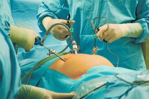 Під час лапараскопічної операції по видаленню жовчного в животі роблять маленькі дірочки до двох сантиметрів у діаметрі. В одну з них заводять телекамеру, в інші — медичні інструменти