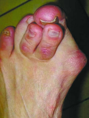 Подагра починається з різкого болю у великому пальці на нозі. Шкіра червоніє, суглоб розпухає 