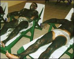 У Трускавці грязями Мертвого моря лікують псоріаз