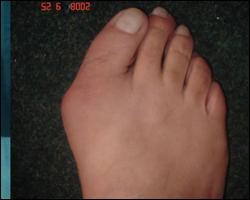 Палець відхиляється всередину стопи через незручне взуття