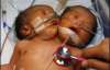 В Азии родился ребенок с лишней головой (ФОТО)