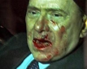 Через вибиті зуби Берлусконі мучить постійний біль