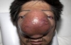 Китайцу с носа удалят гигантскую опухоль (ФОТО)