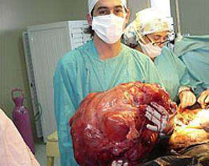 Хирурги впервые удалили 25-килограммовую опухоль