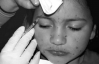 Восьмирічній дівчинці щотижня колють в обличчя ботокс